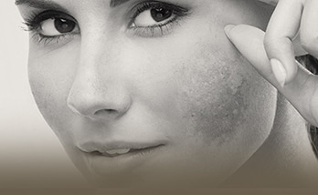 melasma